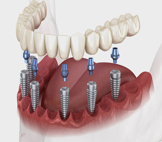 basal-implant-treatment