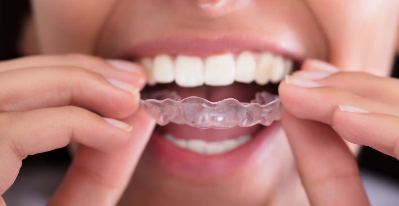 mouth-guard-treatment