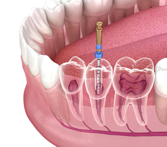 root-canal-treatment